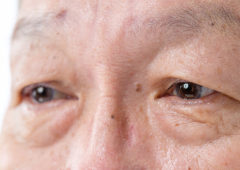 大西メディカルクリニックの眼瞼下垂 画像